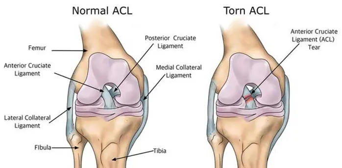 acl surgery recovery